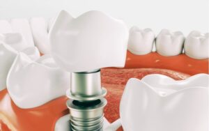 Implanting | Wellington Point Dental Dental Implants